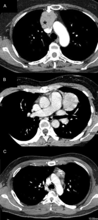 Contrast-enhanced chest CT findings of the pleural recurrent thymoma cases listed in Table 3 following VATS-Tx. (A) Masaoka Stage I and WHO Type AB thymoma in a 56-year old female. The CT image shows an anterior mediastinal mass with a small area of low attenuation (arrow). CT Hounsfield units of this low attenuation area (arrow) and other components (star) are 27 and 100, respectively. Capsule injury was found during surgery. (B) Masaoka Stage I and WHO Type AB thymoma in a 35-year old male. The CT image shows a homogenous, anterior mediastinal mass. The capsule was injured during surgery. (C) Masaoka Stage II and WHO Type B2 thymoma associated with MG in a 36-year old male. The CT image shows a mass in the anterior portion of the mediastinum.