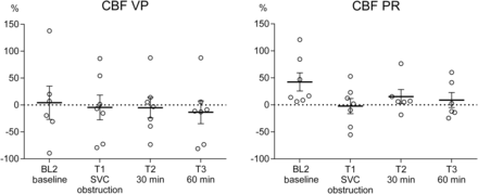 Stepwise cerebral blood flow (CBF) changes, measured by the cortical laser-Doppler technique in pigs during 34°C experimental CPB, with SVC obstruction and interventions in the form of VP respective PR of congestion. Means and SEMs. CBF decreased insignificantly upon SVC obstruction and was restored by PR alone (P = 0.1162). CBF: cerebral blood flow; PR: partial relief of congestion; VP: vasopressor treatment.