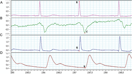 From top to bottom: (A) the ECG and (B) ICG from the impedance cardiograph and (C) ECG and (D) radial arterial pressure curve from the bedside monitor. ISTI was defined as the time interval in milliseconds between the R-point on the ECG and C-wave on the ICG, PEP as the time interval in milliseconds between the Q-point on the ECG and the beginning of the upstroke of the radial arterial pressure curve (U-point).