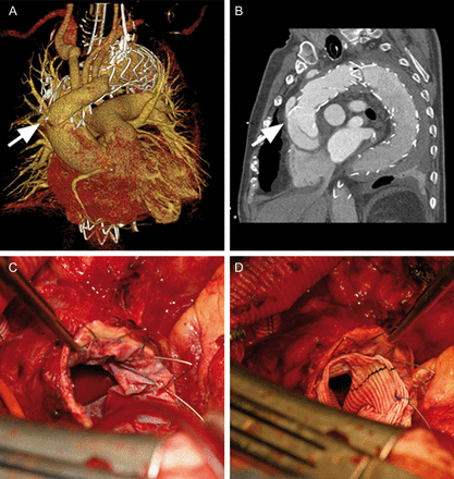 CT 3D reconstruction of the thoracic aorta after supra-aortic de-branching and thoracic endovascular stent graft repair showing retrograde aortic type A dissection (rAAD) due to proximal bare spring perforation (A and B). Intraoperative view of the proximal portion of the deployed stent graft after resection of the ascending aorta (C). An ‘elephant trunk procedure’ was performed by suturing a Hemashield graft to the proximal end of the stent graft (D); the bare springs can be cut off before or after completion of this anastomosis.