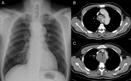 Preoperative plain film and chest computed tomographic (CT) scan. (A) Chest X-ray shows a widening mediastinum. Trachea is not deviated, and the distal tracheal is not well opacified. (B) Horizontal view demonstrates a contained rupture of the thoracic aorta, from a calcified pouch around the ligament arteriosus. Black asteroid indicates the calcified ring near the ligament arteriosus. (C) The contained rupture of thoracic aorta compressed the trachea and oesophagus (white arrow: oesophagus; black arrow: trachea).