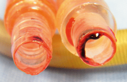 Fibrin over the cannula of the device removed after 66 days.
