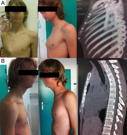 Symmetric case. Same patient with symmetric PC. 16 years old, PIC of 7.5 PSI. History of cardiac surgery by sternotomy. Group I: (A) before treatment and (B) after 11 months of treatment.