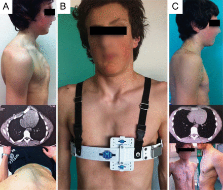 Asymmetric case. Same patient, with asymmetric PC 14 years old. PIC of 8.8 PSI. Group II: (A) before: lateral view, CT scan and upper view, (B) during the treatment and (C) after 7 months of treatment, CT scan, lateral and front view.