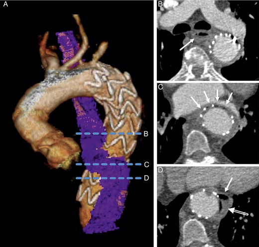 CT of a 58-year old female with AOF after TEVAR for acute complicated type B aortic dissection. (A), volume rendered image displaying the thoracic aorta and the close spatial relation of the stent graft and the oesophagus (blue). Dotted blue lines indicate the position of the transverse views in (B–D): (B) at the level below the tracheal bifurcation with the oesophagus (arrow) located posteriorly to the left main bronchus and medial to the aorta; (C) at the level of the left atrium with the oesophagus (arrows) intersecting anteriorly to the aorta with slit-shaped compression between aorta and left atrium. (D) Further below, the oesophagus is located left to the aorta (arrow) with air adjacent to the stent graft (open arrow), corresponding to the AOF.