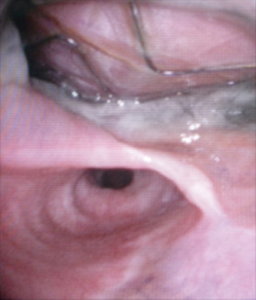 Endoscopic view of AOF showing the stents and fabric of the stent-graft protruding into the oesophageal lumen.