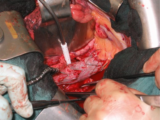 Intraoperative view of a patient with AOF showing the aneurismal sac open, as well as the spatial relation of the stent-graft to the defect in the oesophageal wall.