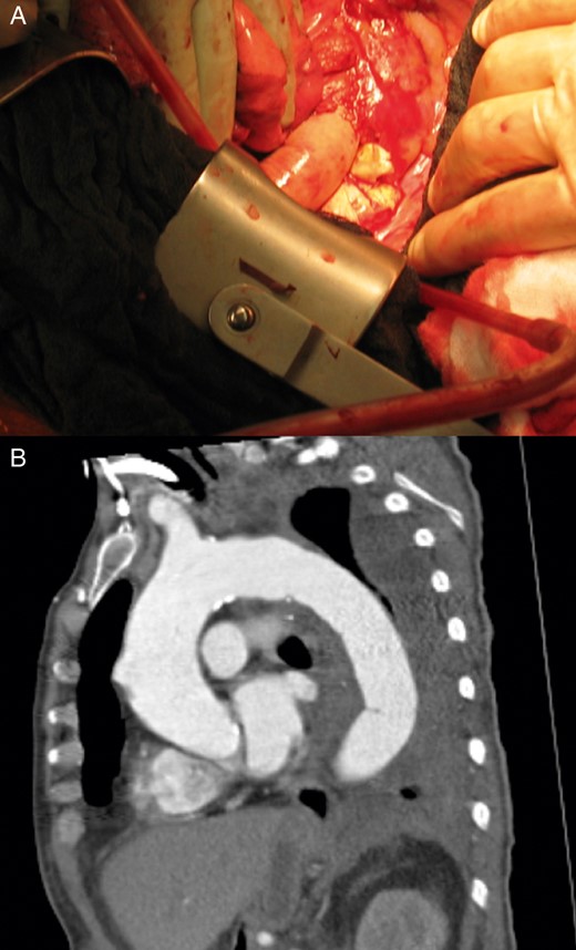 (A). Intraoperative view after oesophagectomy and orthotopic reconstruction with a bovine pericardial neoaorta. (B). CT 3 months after orthotopic aortic reconstruction and gastric pull-up.