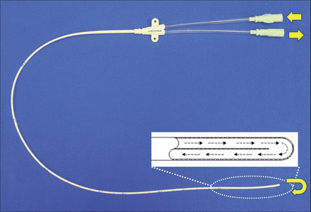 Custom-designed polyurethane epidural catheter. The catheter (16-gauge outer diameter; length, 30 cm) has two ends that form the inlet and outlet of a single U-shaped closed lumen inside it. Cold saline circulates in the closed lumen of the catheter, reversing at tip without leakage.