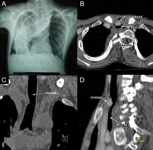 (A) Chest X-ray: severe kyphoscoliosis; (B–D): computed tomography scan: trachea compressed between the innominate artery and a tumour, identified after surgery as neurofibroma.