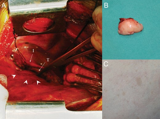 (A) Operative view. Tumour (arrowheads); (B) excised tumour; (C) skin neurofibromatosis lesions. I: innominate artery; T: trachea.