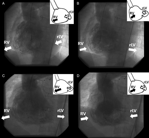 Ventriculography revealed asynchronous ventricular wall motion between the systemic right ventricle and rudimentary left ventricle during sinus rhythm (A and B). During early systole, the rudimentary left ventricle is in systole but the systemic right ventricle is still relaxing. After mid-systole, this association reversed. The synchrony was improved by multisite pacing (C and D). (A) Ventriculography and schema in the early-systolic phase during sinus rhythm. (B) Ventriculography and schema in the mid- to late-systolic phase during sinus rhythm. (C) Ventriculography and schema in the early-systolic phase during multisite pacing. (D) Ventriculography and schema in the mid- to late-systolic phase during multisite pacing. RV: systemic right ventricle; rLV: rudimentary left ventricle.