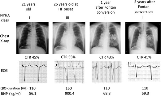 Clinical course before and after Fontan conversion with concomitant arrhythmia surgery and cardiac resynchronization therapy. HF: heart failure; ECG: electrocardiogram; CTR: cardiothoracic ratio; BNP: brain natriuretic peptide.