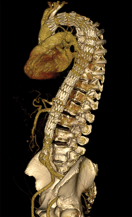 Extent I thoraco-abdominal aortic aneurysm with fenestration for the left subclavian artery and four fenestrations for the visceral and renal arteries.