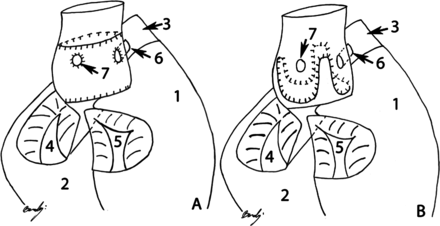 Schematic drawing of the root replacement technique (A) and sub-coronary implantation technique (B). Note in both schematic drawings that the aortic root is viewed from the posterior side. The left and the right atrium were removed. (A) The root replacement technique is seen with horizontal suture line at the neoaortic root base and sinutubular junction. In this case, the left and right coronary artery ositum has to be reimplanted into the wall of the neoaortic root. (B) Sub-coronary implantation technique is seen. Here, the suture line is positioned under the ostium of the left and right coronary artery. Note that the suture line has a semilunar shape and is placed at nadirs of the native aortic valve leaflets. In this technique, there is no need for reimplantation of the coronary ostia. 1. Right ventricle, 2. left ventricle, 3. pulmonary artery, 4. mitral valve, 5. tricuspid valve, 6. right coronary artery and 7. left coronary artery.
