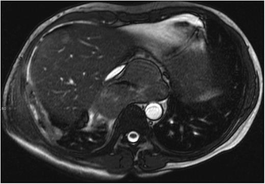 Magnetic resonance imaging of the chest showing an irregular and partially cystic mass involving the oesophagus with significant compression of the inferior vena cava and suprahepatic veins with hepatomegaly and mild ascites.
