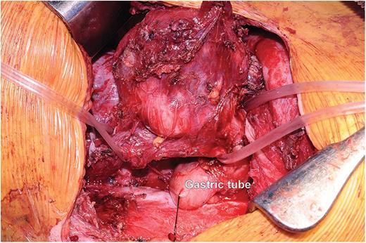 Intraoperative image after right thoracotomy showing the giant leiomyoma. The proximal oesophagus and the distal oesophagus are encircled with Nelaton's catheters. A gastric tube for oesophageal replacement has been already prepared and is visible in the chest.