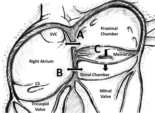 Schematic demonstration of the fibromuscular membrane dividing the left atrial cavity into two chambers. Possible ways of communication between the proximal left atrial chamber, right atrium and the distal chamber (true left atrium) are demonstrated. The communication may lie between the proximal chamber and the right atrium (A) and/or between the right atrium and the distal chamber (B) and/or through the fenestrations on the membrane (C). SVC: superior vena cava; CS: coronary sinus.