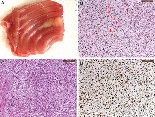 (A) Macroscopic appearance of a tumour derived from IL45-Luc cells. A white tumour nodule is found around the injection site. (B) In an H&E staining and indicated by arrow; tumour cells (T), stromal part containing blood vessels (V), lymphocytes (L) and fibroblasts (F). (C) Collagen staining showing the presence of collagen bundles (red) infiltrates. (D) Ki67 staining (brown) of tumour cells.