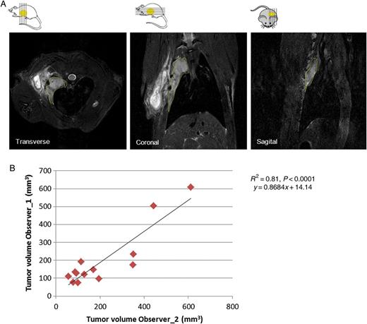 (A) Example of MR images (transverse/coronal/sagittal); the margins of tumour area are indicated with yellow lines. (B) Significant correlation of tumour volumes quantified in transverse images by two independent observers (n = 13).