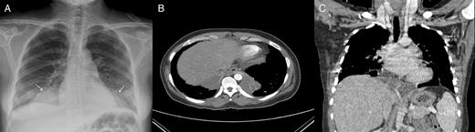 (A) Chest X-ray showed a round and well-defined mass consolidation of the right lower lung field and a similar one of the left lower lung field. (B and C) A computed tomographic scan of the chest revealed bilateral, large-sized pneumonic consolidation in the paravertebral region of the left and right lower lobe (B, arrow) with a possible bridging tunnel behind the heart and showed that an aberrant artery, which originated from the coeliac trunk, supplied the sequestration of the right lower lobe, and that a branch from the aberrant artery traversed to the sequestration in the left lower lobe through a bridging isthmus (C, arrows).