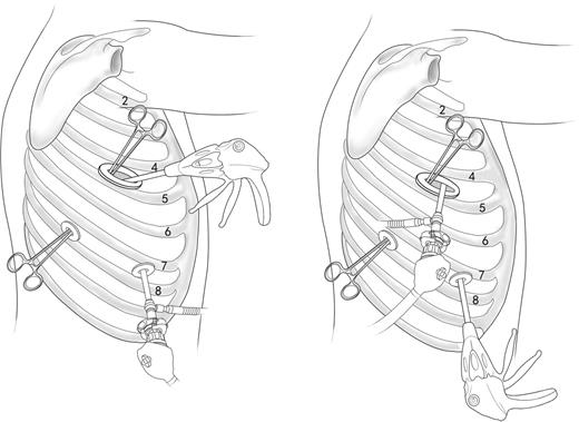 Incisions for the operation. A soft incision protector was used for the main incision which was located in the fourth or fifth intercostal space between the anterior and posterior auxiliary line. Two 1.2-cm-long incisions were placed in the sixth or seventh intercostal space at the middle auxiliary line and posterior auxiliary line individually. Position of the camera and endo-stapler could exchange positions depending on convenience of operation.