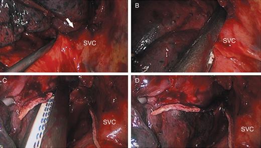 Details for removal of the partial wall of SVC. (A) the lesion invading the SVC; (B) the side wall of the SVC clamped by the endo-stapler; (C and D) the side wall of SVC cut out; SVC: superior vena cava; arrow: the SVC invaded by lung cancer.