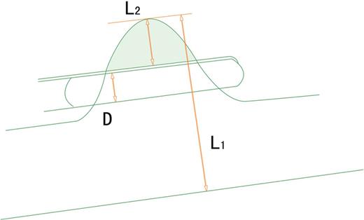 Relation between the lesion, SVC and endo-stapler. L1 = 1/2 circumference = 1/2 (π × diameter of superior the vena cava); L2 = 1/2 width of the invaded SVC; D = width of the endo-stapler, 1/2 ≥ (D + L2)/L1, 1/2 − D/L1 ≥ L2/L1, 1/2 − D/πr ≥ L2/L1. The width of the endo-stapler is ∼1 cm and the diameter of the SVC of the Chinese population is ∼2 cm (r ≈ 1 cm), so L2/L1 is simplifies to less than 1/6; SVC: superior vena cava.