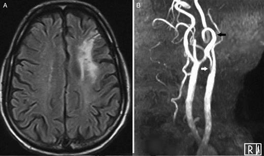 (A) Brain magnetic resonance imaging axial fluid-attenuated inversion recovery image demonstrating hyperintensity in the left fronto-parietal region suggestive of infarct. This patient had recurrent transient right upper limb monoparesis. (B) A magnetic resonance imaging time-of-flight angiogram depicting critical stenosis at the left internal carotid artery bulb (white arrow) with 360° coiled distal internal carotid artery (black arrow).