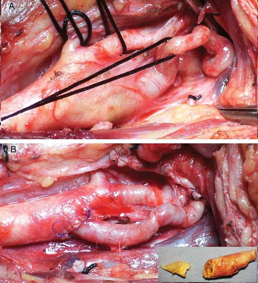 (A) Intraoperative image after dissection of carotid arteries showing plaque-bearing segment of the internal carotid artery bulb, severely coiled and redundant distal internal carotid artery, external carotid artery and superior thyroid artery. Internal carotid artery (ICA) tortuosity from vessel wall weakening can be an aftermath of ageing and atherosclerosis while congenital tortuosity accelerates atherosclerosis by producing flow irregularities. (B) Reimplantation of the straightened and spatulated internal carotid artery onto the carotid bifurcation. Advantages of the ICA ‘resection and reimplantation’ technique include rapid plaque extraction obviating the need to do ICA endarterectomy, decreased susceptibility to restenosis and avoidance of prosthetic patch material. (inset) Resected plaque-bearing segment of internal carotid artery along with endarterectomized common carotid artery plaque. The proximal disease at the common carotid artery (CCA) end was cleared though a sufficient arteriotomy prior to reimplantation of healthy distal ICA onto the CCA.