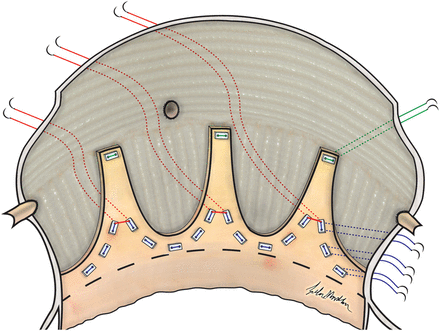 Sub-commissural annuloplasty in tricuspid aortic valve is performed by placement of three non-pledged sutures (2–0 prolene) through the holes of all six pledges that are placed next to the commissures on annular level; forming three pairs.