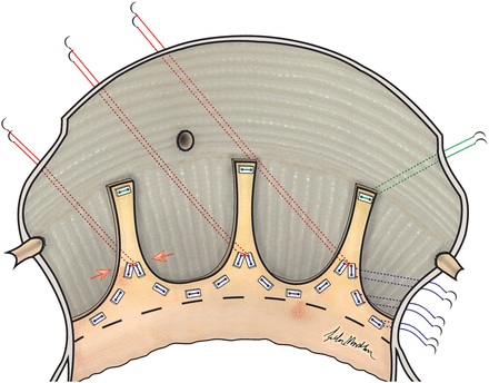 Annular reduction as a result of sub-commissural annuloplasty in tricuspid aortic valve.