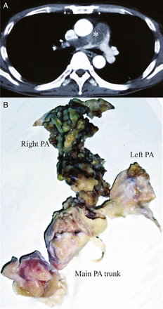 (A) A computed tomography image showing an obstructive pulmonary tumour extending from the main pulmonary trunk into the bilateral branches. Asterisk denotes the tumour. (B) The resected specimen of the tumour endoarterectomy. PA: pulmonary artery.