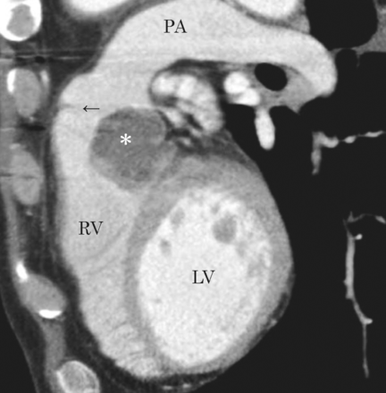 A computed tomography scan demonstrating a recurrent sarcoma in sagittal view. Asterisk denotes the tumour. Arrow: pulmonary valve; RV: right ventricle; LV: left ventricle; PA: pulmonary artery.
