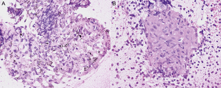 Representative pathological findings of PET false-positive lymph nodes. Pathological findings of false-positive cases by FDG-PET showed (A) chronic inflammation manifested by histiocytes phagocytizing coal dust and (B) epithelioid cell granulomas.