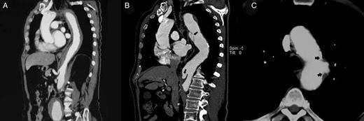 (A) CT image of an intramural haematoma in the descending thoracic aorta at the diagnosis of the acute aortic syndrome. (B) Development of two ulcer-like projections in the same patient at sixth months CT control (black arrows). (C) Penetrating atherosclerotic ulcer in the aortic arch. Significant atherosclerosis and calcification of the borders of the lesion (black arrows) with deformation of the external morphology of the vessel.