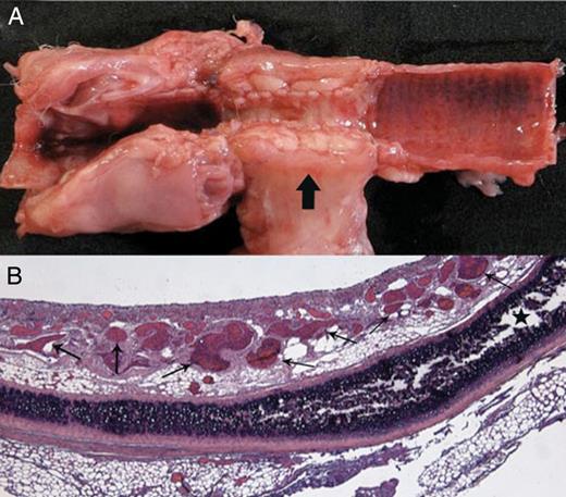 Transplantation of a long tracheal allograft segment after prior heterotopic revascularization (Rabbit 1). (A) Macroscopic aspect on Day 3: longitudinal section of the central airway showing stenosis of the fascial flap-wrapped graft, and circumferential thickening of the fascia (arrow). (B) Histological examination of the graft showing numerous neovessels in the lamina propria (small arrows), and a viable cartilage ring (star) (haematoxylin–eosin–saffron stain ×25).
