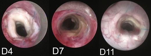Bronchoscopic examination showing a whitish aspect of the graft lumen on Day 4. Signs of epithelial regeneration/revascularization mainly in the posterior wall of the graft appearing early on Day 7; and then, extending rapidly around the entire circumference on Day 11 (80% regeneration/revascularization).