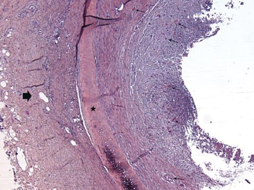 Histological examination of a fascial flap-wrapped TA segment after orthotopic transplantation on Day 9: almost complete obliteration of the graft lumen due to fibroblastic proliferation originating from the lamina propria rich in neocapillaries (small arrows); the cartilage ring is viable (star); the block arrow shows the surrounding fascia (Rabbit 3).