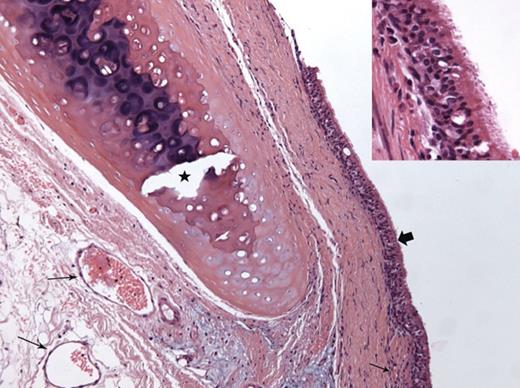 Histological examination of a TA segment after single-stage orthotopic revascularization (Rabbit 13, sacrificed on Day 101): evidence of graft revascularization (small arrows); respiratory epithelial regeneration is complete (block arrow and inset); collagenized fibrosis of the subjacent lamina propria, albeit with no thickening; the cartilage ring has been decalcified (star) (haematoxylin–eosin–saffron stain ×200; inset ×400).