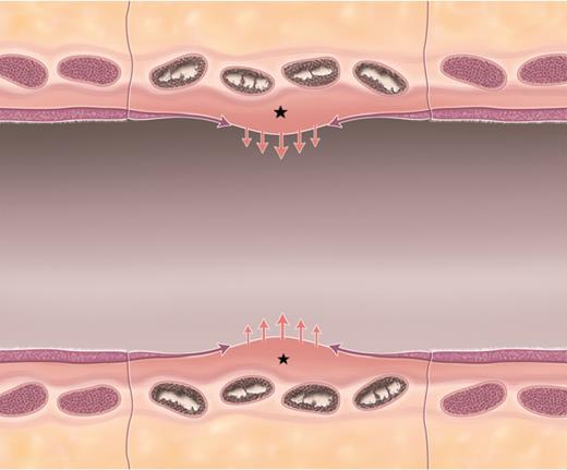 Schematic of ‘competition’ between fibroblastic proliferation and re-epithelialization. Longitudinal view of a short length free tracheal graft segment (central segment). The schematic shows transverse sections of four cartilage rings in the process of calcification. Pink arrows show the tendency of fibroblastic proliferation originating from the lamina propria (stars) trending towards stenosis in all grafts. Possibly countering or limiting this stenotic proliferation, purple arrows show the concomitant re-epithelialization of the airway surface. Thus, a hypothetical ‘competition’ between these two processes and their relative intensity and/or speed may explain the variable evolution over time of different graft lengths towards stenotic complications or moderate stenosis manageable through bronchoscopic interventions.