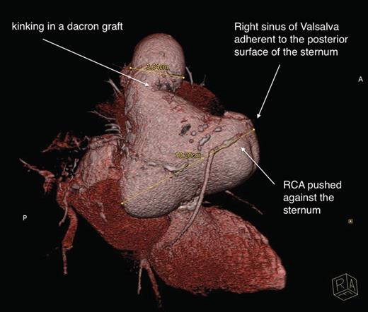 Severely enlarged aortic sinuses. Right coronary artery (RCA) modelled by the right aortic sinus.