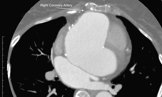 Right coronary artery adherent to the sternum, displaced by the enlarged right coronary sinus.