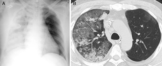( A ) Chest radiography of Case 1 shows a diffuse ground-glass attenuation of the right lung. ( B ) Chest computed tomography of Case 5 shows obvious unilateral change with alveolar consolidation and septal thickening.