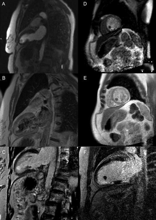 Cardiac magnetic resonance imaging demonstrating perfusion, T1 images post-gadolinium and delayed enhancement of a left ventricular apical fibroelastoma (A–C) and thrombus (D–F), respectively.