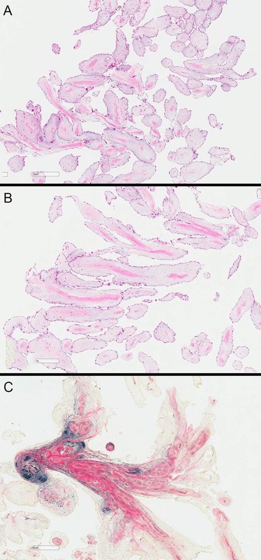 (A) Low power haematoxylin and eosin stain, showing delicate papillary fronds covered by endothelium; (B) higher power view showing condensation of connective tissue, including elastin, at the core of the papillary fronds; (C) elastin and van Gieson method (EVG) showing the elastin stained black.