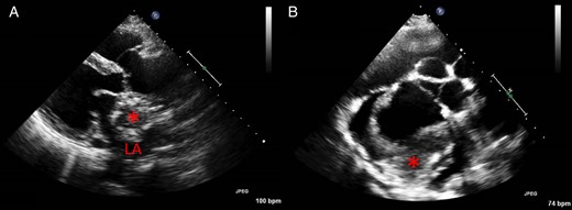 ( A ) Transthoracic echocardiography initially showed a huge mass (asterisk) inside the left atrium in the parasternal long-axis view. The border between the mass and the aortic root was uneven, and there was significant aortic insufficiency. ( B ) A short-axis view at the aortic root level eventually revealed that the ‘intracardiac mass’ was an aneurysm with an intraluminal thrombus (asterisk) arising from the non-coronary sinus of Valsalva, with a significant asymmetrically elongated annulus. LA: left atrium.