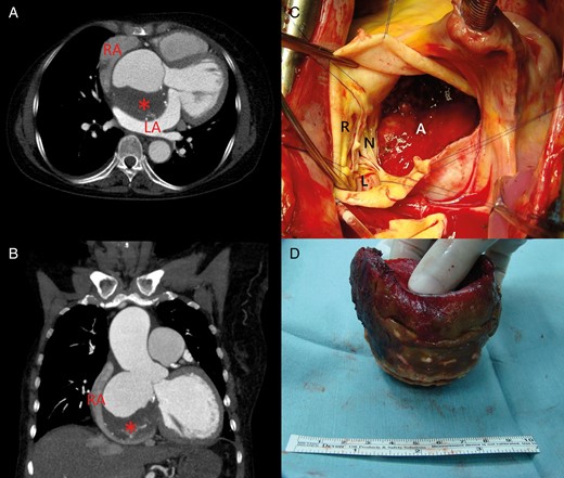 ( A and B ) Computed tomographic angiography showed the 8 cm, non-coronary sinus of Valsalva aneurysm with an intraluminal thrombus (asterisks) and externally compressed left and right atria. Significant aortic insufficiency and the aneurysm's external compression of both atria contributed to the clinical manifestations of the patient. ( C ) After cardiopulmonary bypass and an aortotomy, a severely deformed aortic root geometry caused by the elongated annulus of the non-coronary cusp was noted, which made valve-sparing root replacement unfeasible. ( D ) A well-formed, laminated thrombus was found inside the aneurysm and was removed completely. The patient underwent successful composite aortic root replacement plus a porcine bioprosthetic valve implantation with reimplantation of both coronary buttons. RA: right atrium; LA: left atrium; A: aneurysm; L: left coronary cusp; R: right coronary cusp; N: non-coronary cusp.
