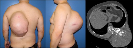 Giant chondrosarcoma located on the left posterior chest wall. A CT scan showed a partially calcified mass originating from the 11th costovertebral junction.