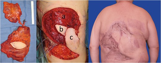 On the left side: Combined myocutaneous latissimus dorsi and serratus anterior free flap pedicled on the thoracodorsal vessels. In the middle: Soft tissue coverage with the contralateral combined latissimus dorsi and serratus anterior free flap. ( a ) Latissimus dorsi and serratus anterior muscle. ( b ) Monitoring skin paddle. ( c ) Lumbar fasciocutaneous flap transposed to secure the distal part of the free flap. On the right side: cosmetic result after split-thickness skin graft and 18 months of follow-up.
